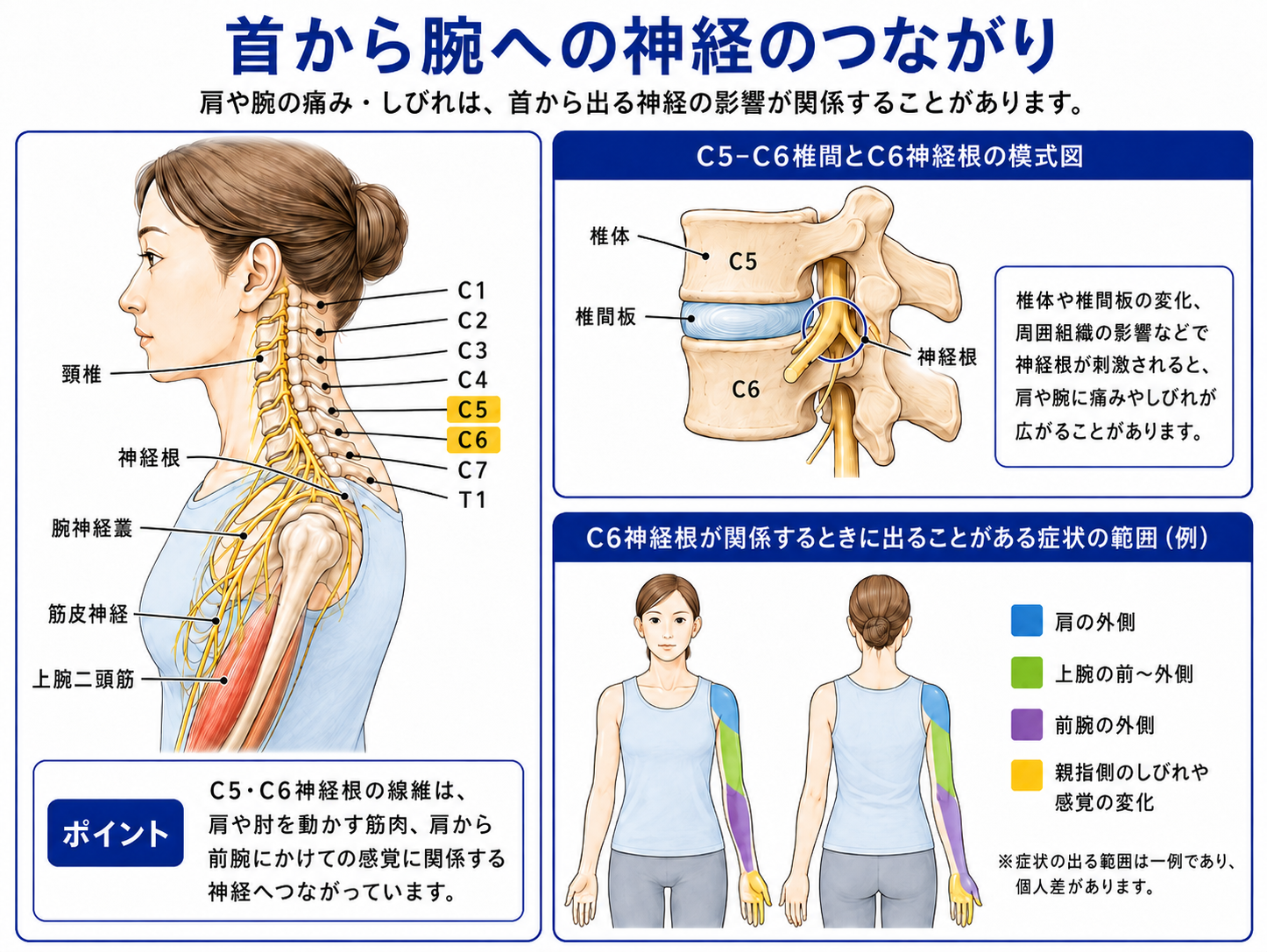 頚椎から出る神経が腕神経叢を通って肩や上腕へつながり、C6神経根が関係する時の症状範囲を示した図解